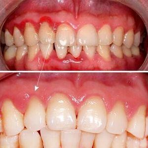 牙齿松动可以修复吗？如果牙掉了做连桥冠好还是种牙好？