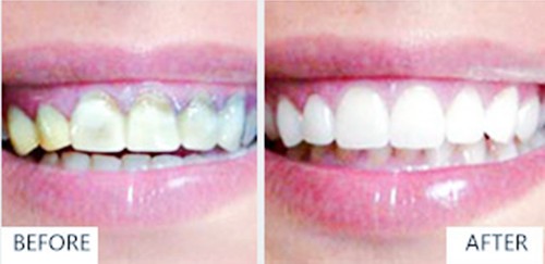 超薄全瓷牙齿贴面多少钱一颗？能维持多久？几年后效果怎么样？