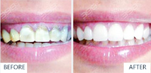 超薄全瓷牙齿贴面几年后效果怎么样？