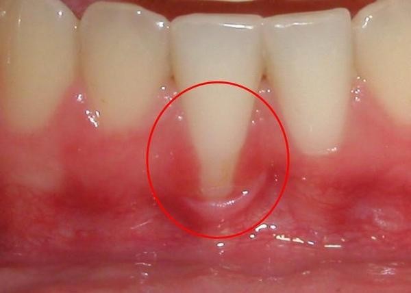 牙龈萎缩牙根暴露是怎么造成的？