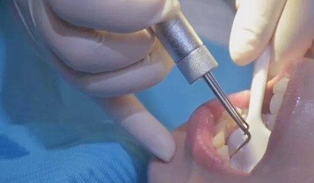 医生为什么让做牙周刮治，龈下刮治后反而越来越严重了！