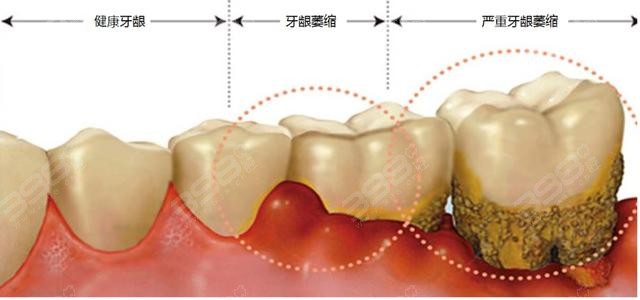 牙龈萎缩程度图