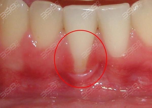 牙根暴露牙龈萎缩的原因有哪些呢