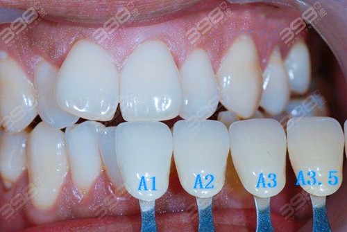 门牙错位怎么矫正牙齿？隐形牙箍和钢牙的利弊分析