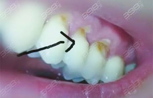 牙齿美学修复：楔状缺损怎么办？补牙多少钱一颗？