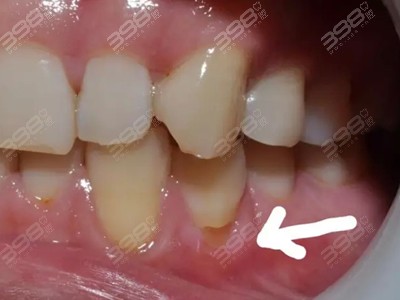 牙齿楔状缺损怎么办？千万不要盲目补牙，告诉你牙齿楔状缺损的修复方法