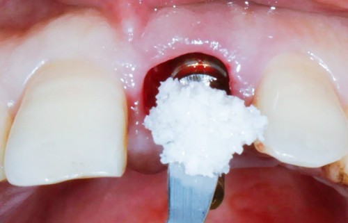 合肥种植牙医院哪家好？植骨种植牙成功率高吗？品牌怎么选？