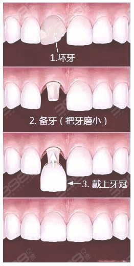 门牙做全瓷牙的过程图