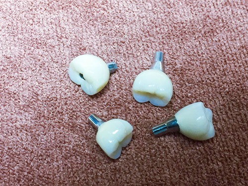 种植牙一体冠和分开的哪个好？在北京做全口牙多少钱？