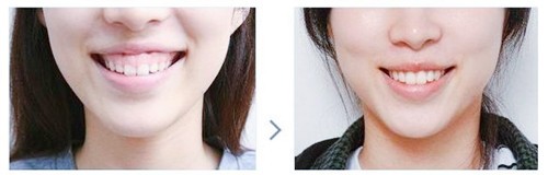 北京牙齿矫正攻略：磨牙缺失，可以用正畸来关闭牙缝吗？