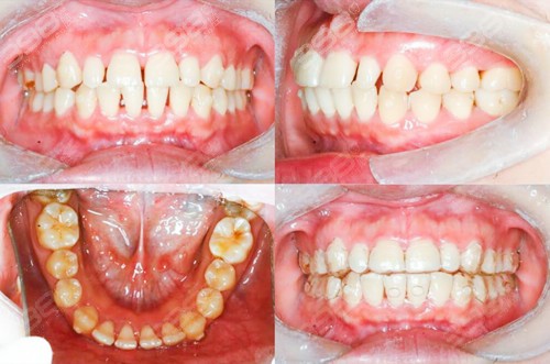牙缝比较大，做牙齿贴面还是牙齿矫正？