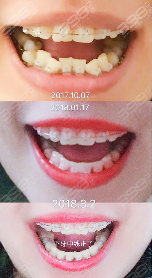 陶瓷牙齿矫正效果怎样？