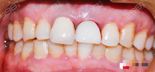种植牙手术改善牙齿缺失问题