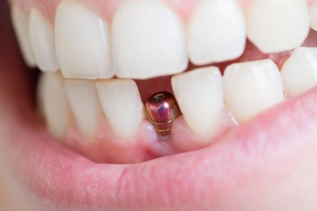 种植牙手术有风险吗？郑州植牙不错的牙科有推荐吗？