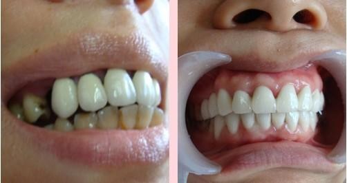 缺牙修复方法有哪些？上海老年人装假牙哪里比较好？