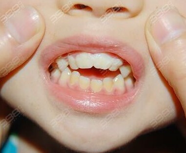 牙齿发育异常包括哪些