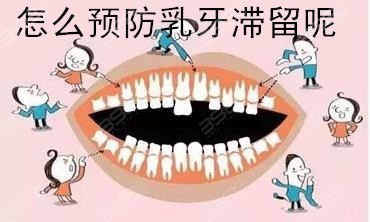 怎么预防乳牙滞留