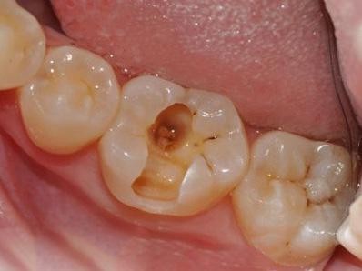 千万不要去补牙洞，医生补牙牙洞变得越来越大
