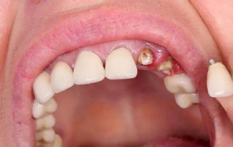 镶牙有几种方式哪个好？固定牙和种植牙有什么区别？