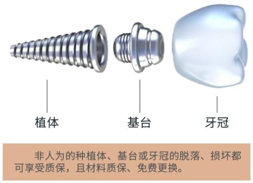 北京钛植口腔医院怎么样？即刻负重半口种植牙多少钱？