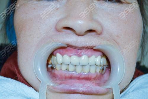 牙冠戴10年了里面的牙怎么样了？
