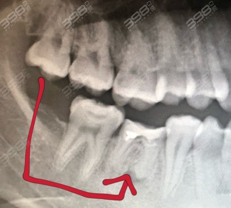 牙齿移植手术