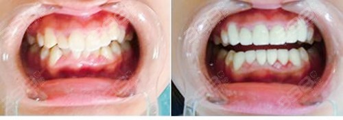 牙齿矫正改善牙齿问题