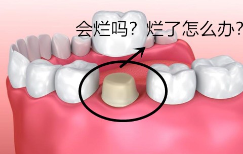 全瓷牙套里的牙会烂吗？如果牙套里面的牙烂了怎么办？