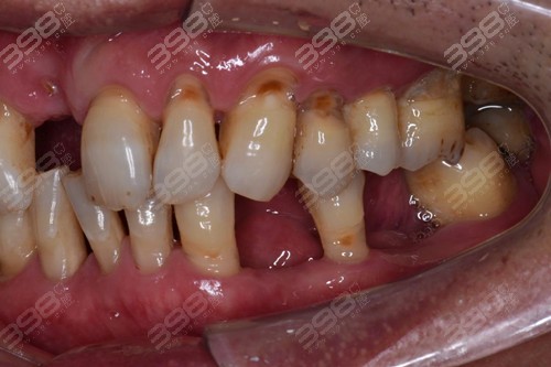 北京靠谱的牙科医院做三颗种植牙多少钱？15000贵不贵？