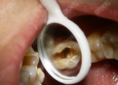 急性牙髓炎案例