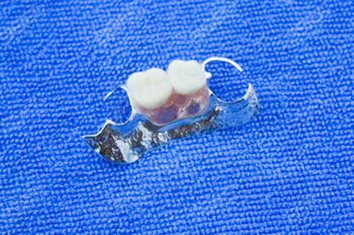 活动假牙大牙能用多久？
