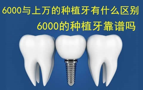 6000的种植牙与上万的有什么区别？6000的种植牙靠谱吗？