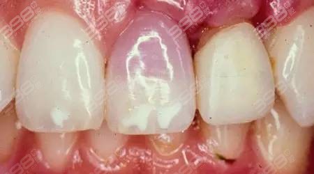 牙齿受力问题