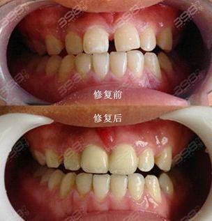 全冠修复修复牙缝案例对比