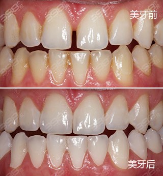 瓷贴面修复牙缝案例