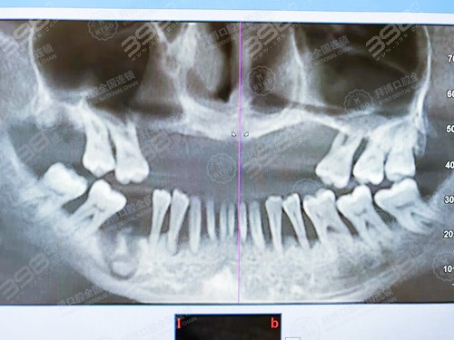 30岁牙周炎导致牙齿缺失，怎么修复好？