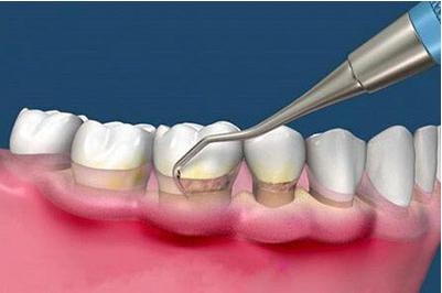 医生洗牙为什么要将牙龈翻开？这会伤害到牙龈吗？
