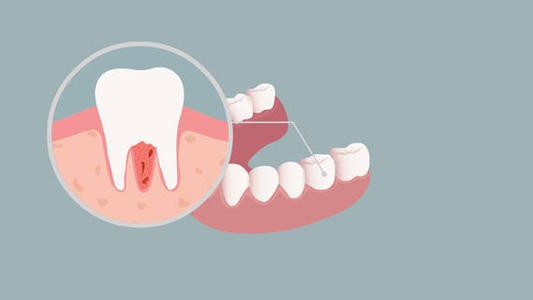 牙龈炎、牙周炎、牙髓炎名字这么像，到底有什么区别？