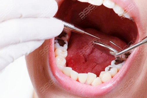 深龋可以直接补牙吗？露一点牙髓补牙还是根管？多少钱？