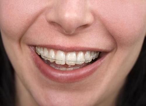 箍牙过程中，成年人的牙套脸几率更大？隐形牙套能避免吗？