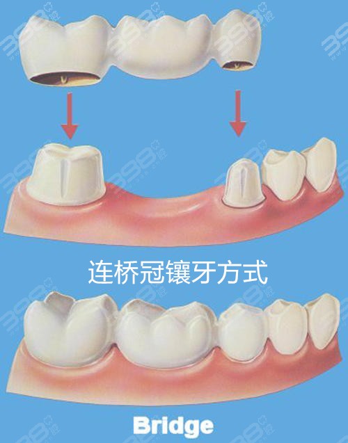 镶牙过程图解：镶牙有几种方式哪个好？