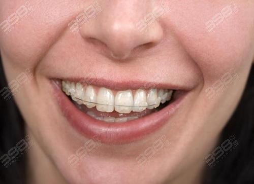 箍牙过程中，成年人的牙套脸几率更大？隐形牙套能避免吗？