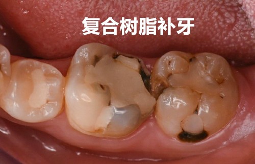 复合树脂补牙和纳米树脂补牙有什么区别？能用多少年？
