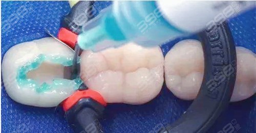 复合树脂补牙和纳米树脂补牙有什么区别？