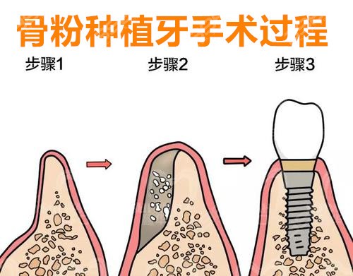 骨粉种植牙手术过程