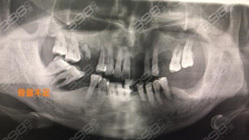 骨粉种植牙手术疼吗？