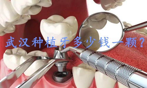 武汉种植牙多少钱一颗？最新武汉口腔医院种植牙品牌价格公布