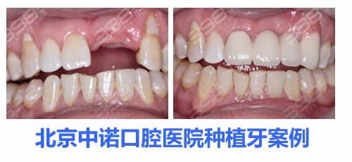 中诺口腔种植牙案例