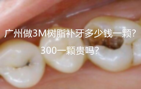 广州做3M树脂补牙多少钱一颗？300一颗贵吗？