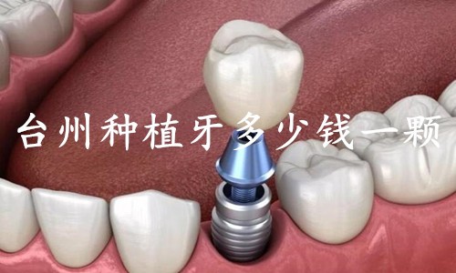 台州当地人揭晓：台州种植牙哪家医院好？种植牙多少钱一颗？